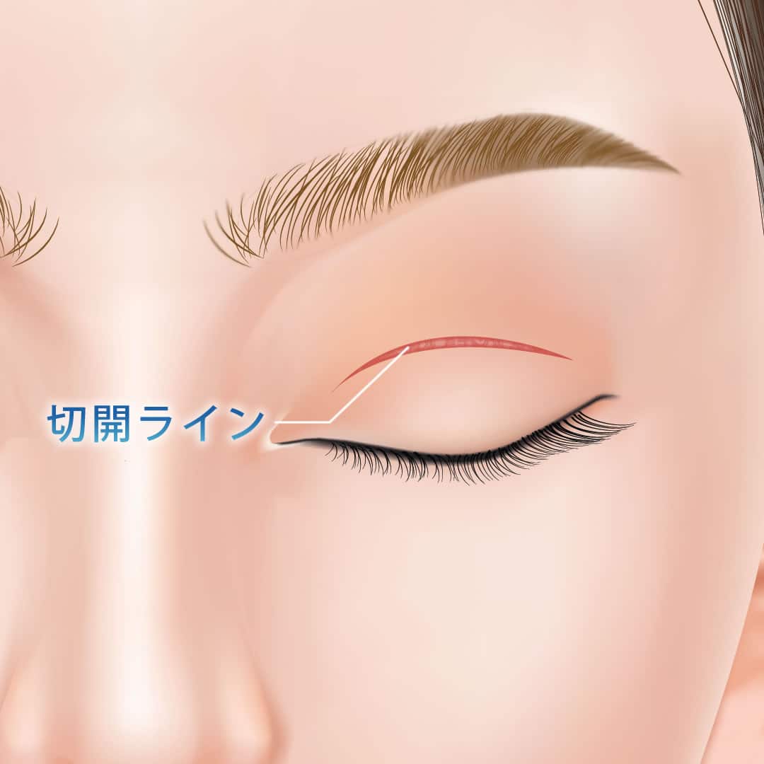 全切開