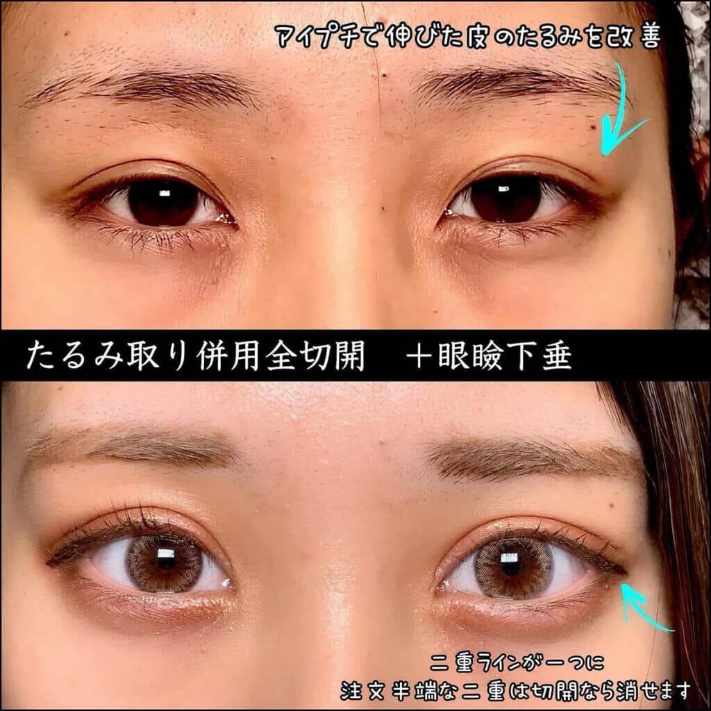 eclinic大阪院のたるみ取り併用全切開二重術+眼瞼下垂+