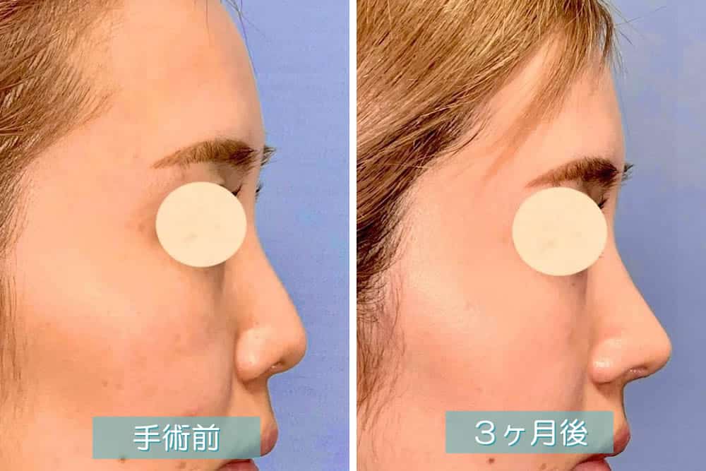 鼻尖部軟骨移植の3ヶ月後の症例