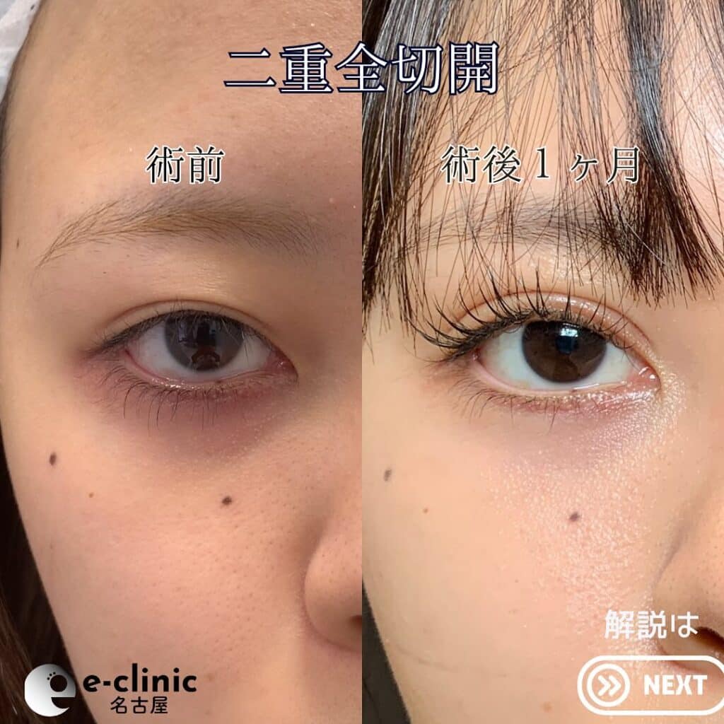 eclinic大阪院の全切開二重術