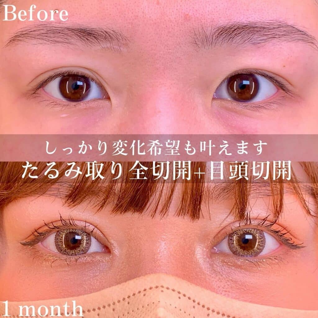 eclinic大阪院の全切開二重術+目頭切開