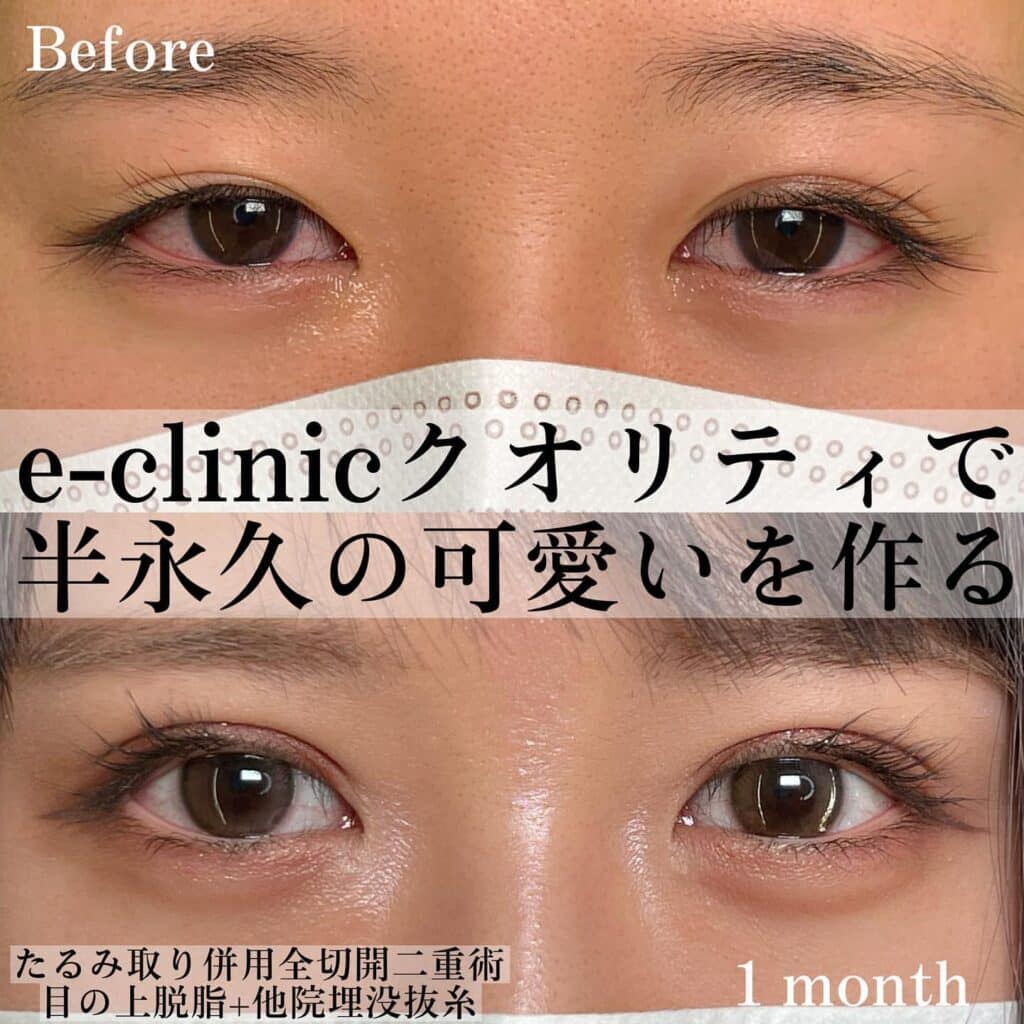 eclinic大阪院のたるみ取り併用全切開二重術+目の上脱脂+他院埋没抜糸