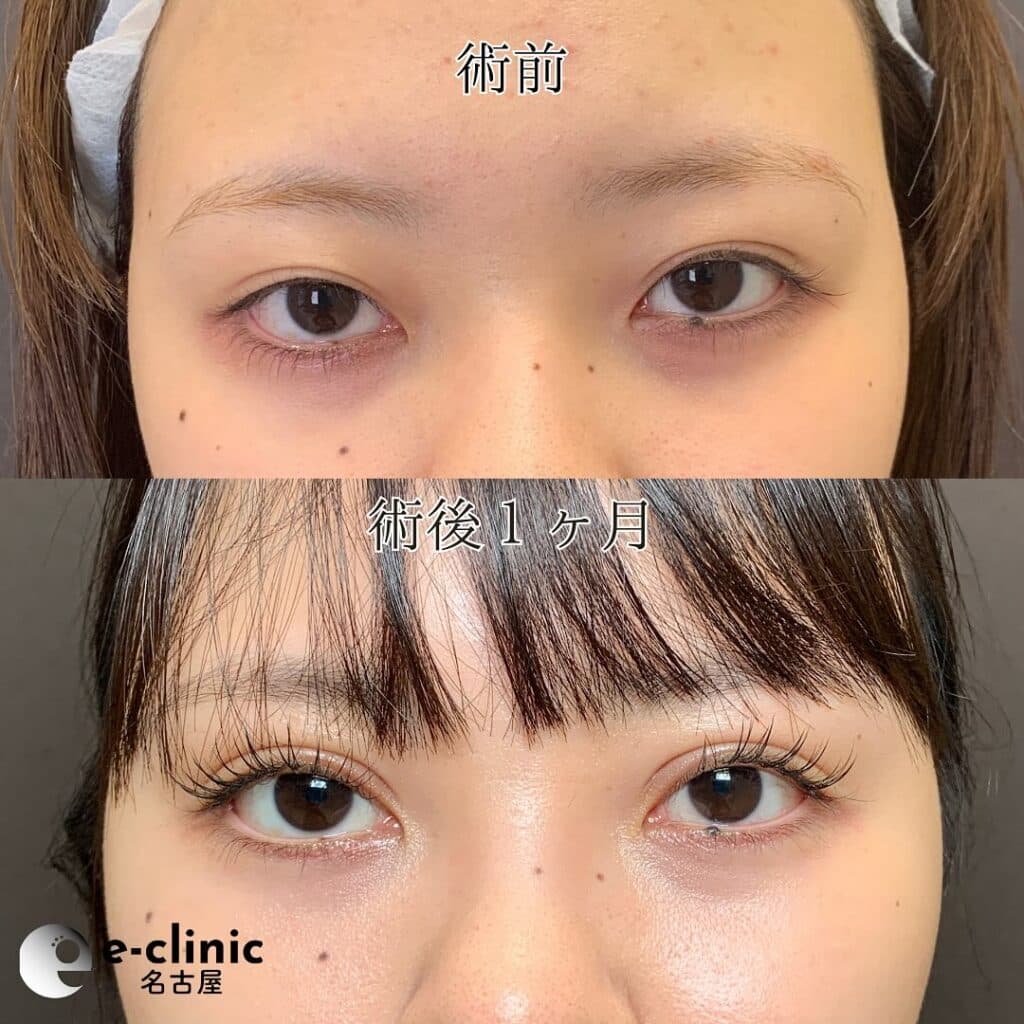eclinic大阪院の全切開二重術