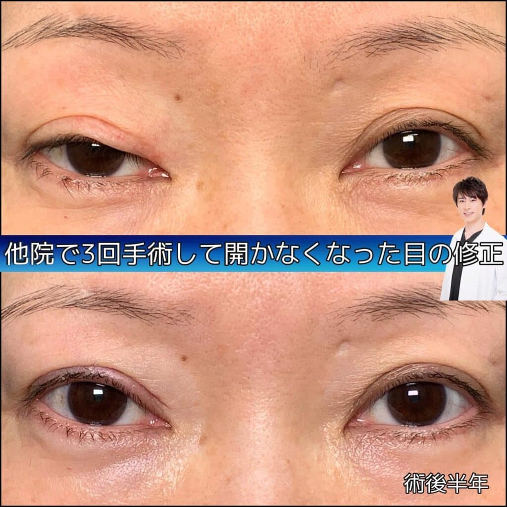 eclinic大阪院の全切開二重術の他院修正