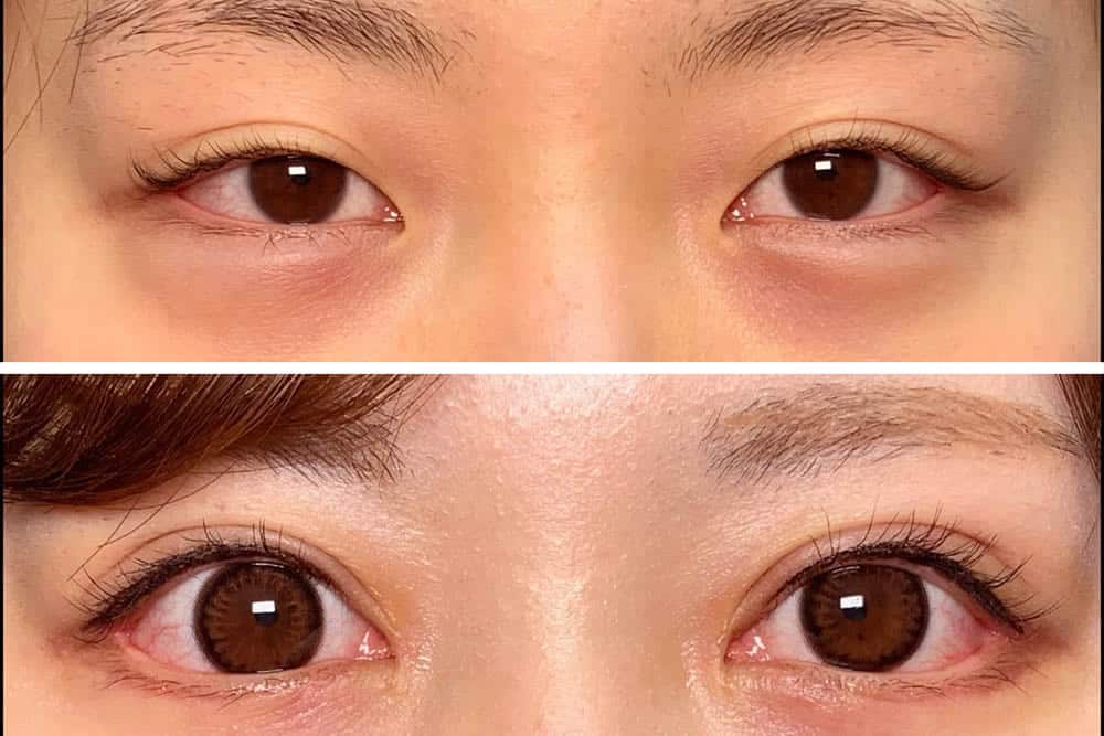 目頭切開と目尻切開との同時手術をした症例写真
