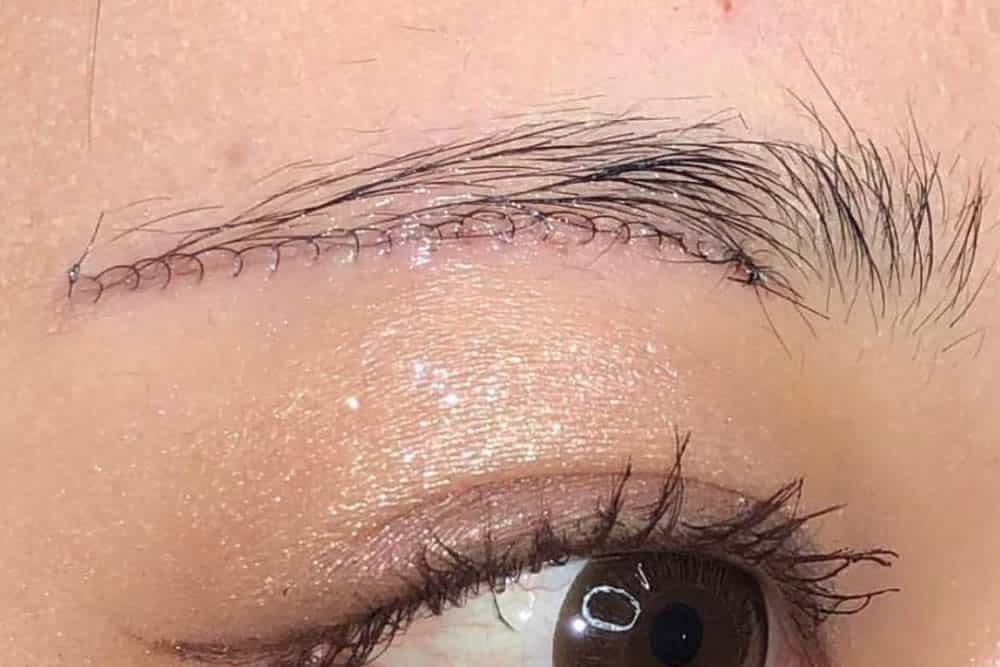 眉下切開の術後の傷跡