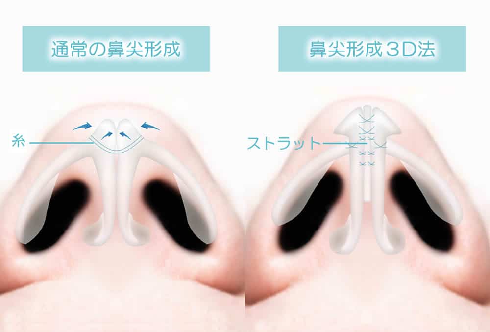 通常の鼻尖形成 と３D法