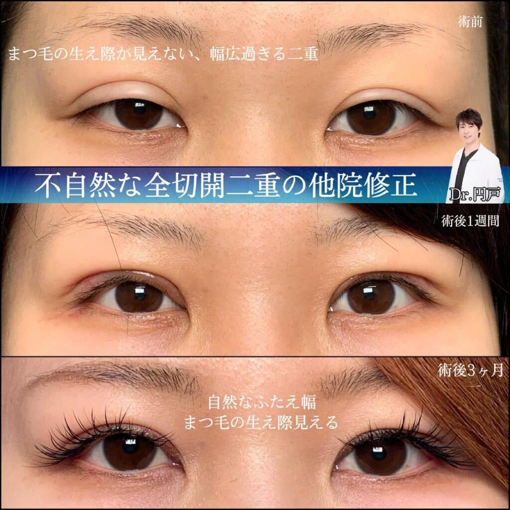 eclinic大阪院の全切開二重術の他院修正