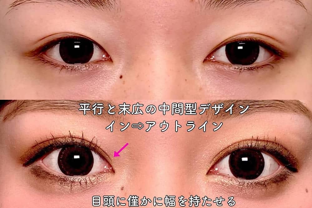 eclinic大阪院の二重埋没法