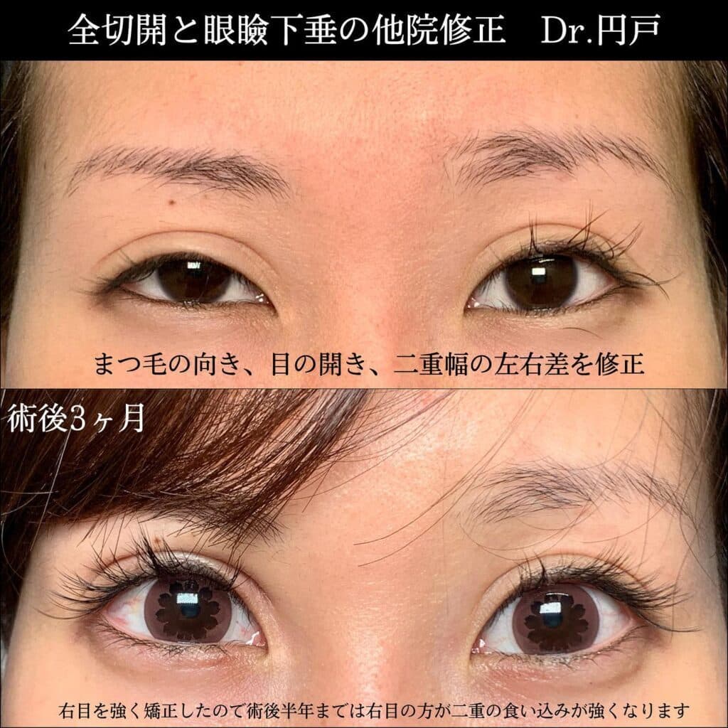 eclinic大阪院の全切開二重術+眼瞼下垂の他院修正