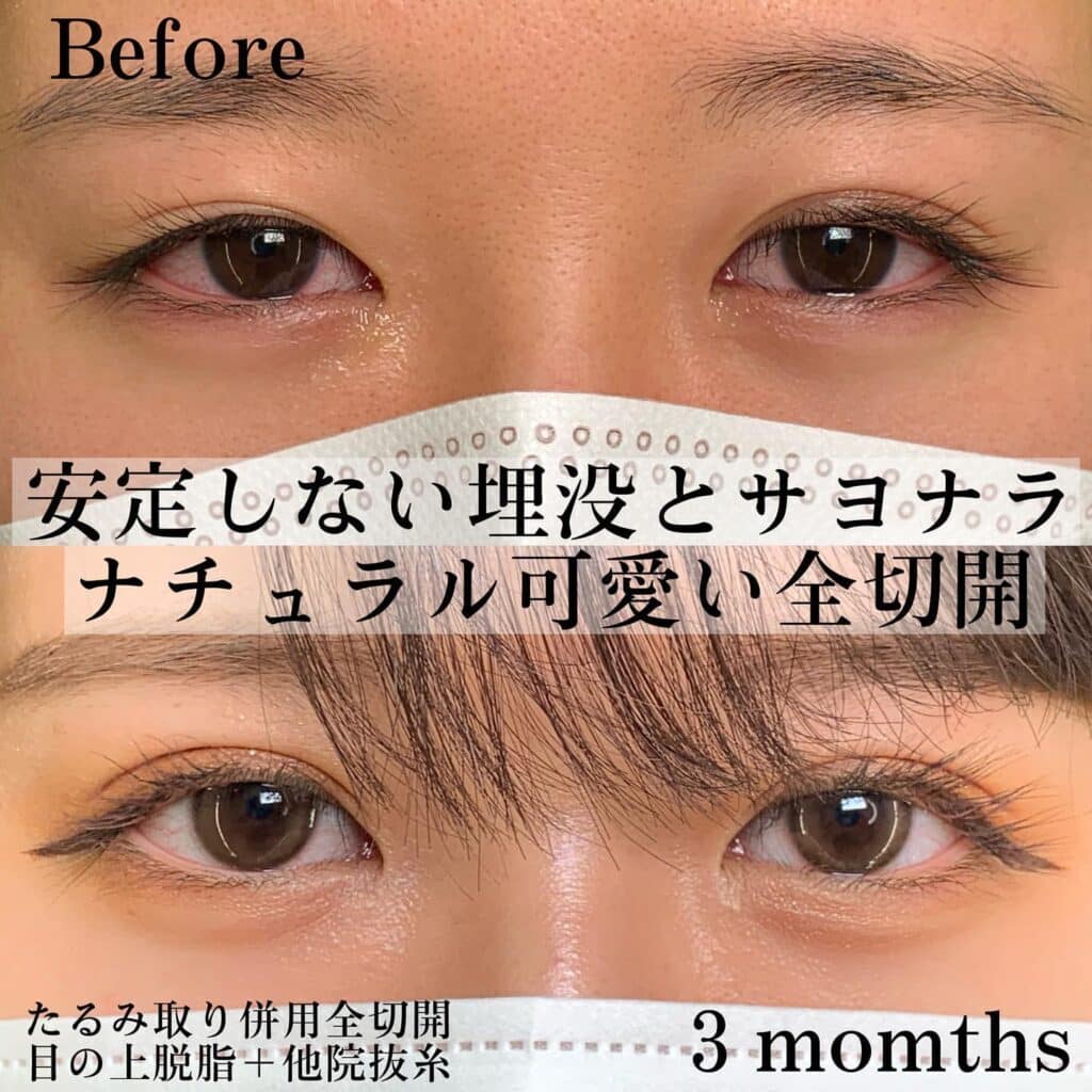 eclinic大阪院の全切開二重術の他院修正+目の上脱脂+他院埋没抜糸