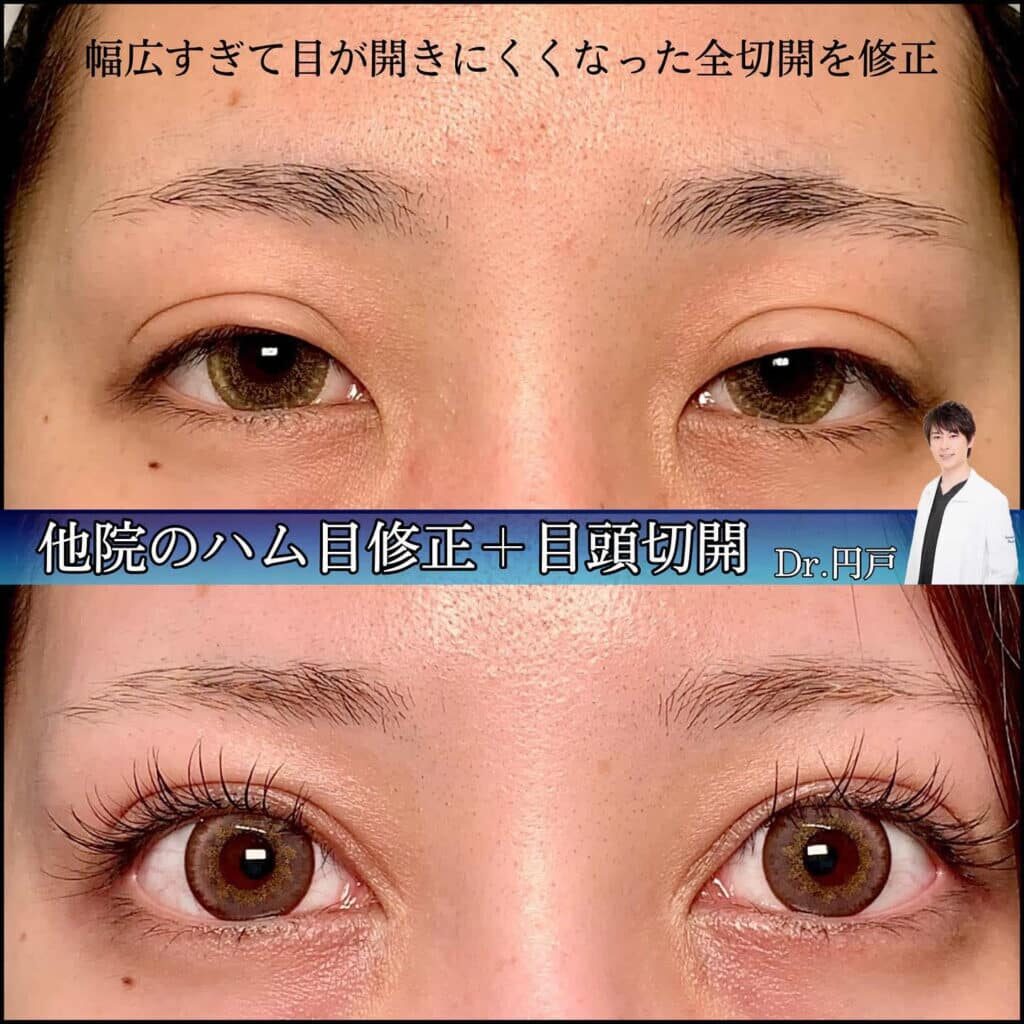 eclinic大阪院の全切開二重術+目頭切開の他院修正(ハム目修正)