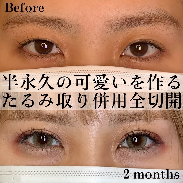 eclinic大阪院のたるみ取り併用全切開二重術