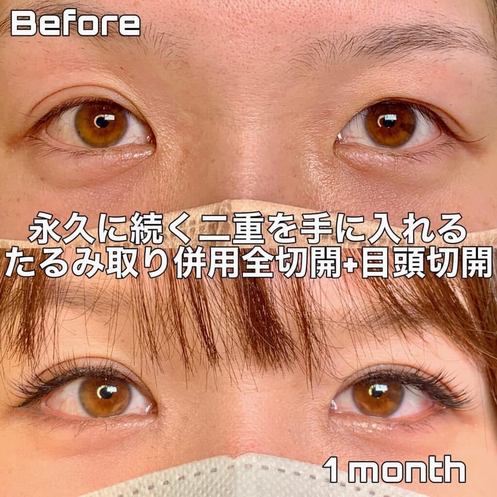 eclinic大阪院のたるみ取り併用全切開二重術+目頭切開