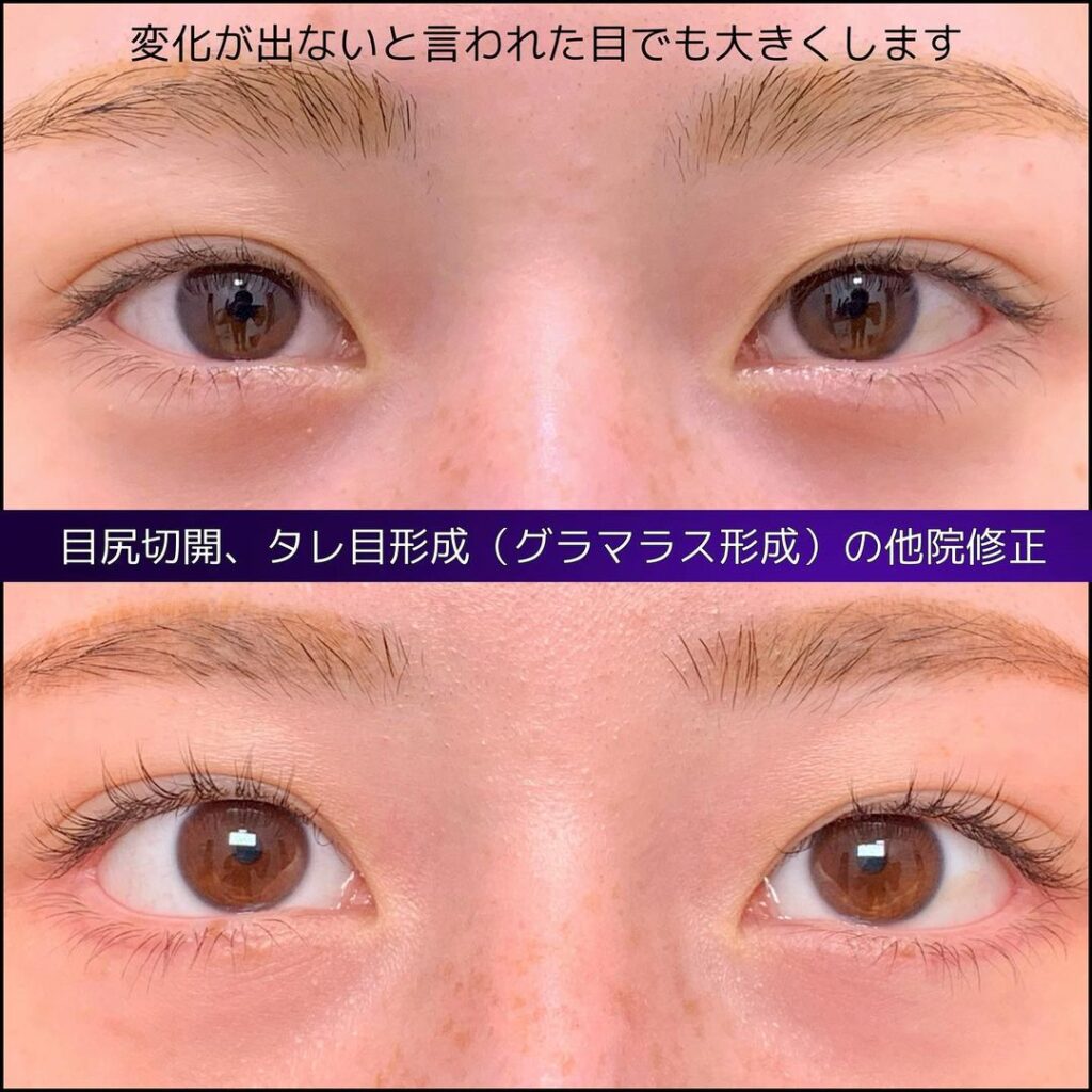 目尻切開＋タレ目形成（他院修正）の症例