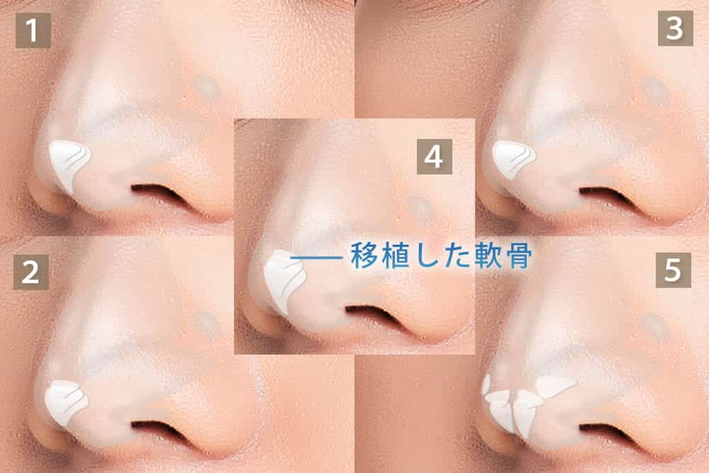 鼻尖軟骨移植の5つのパターン