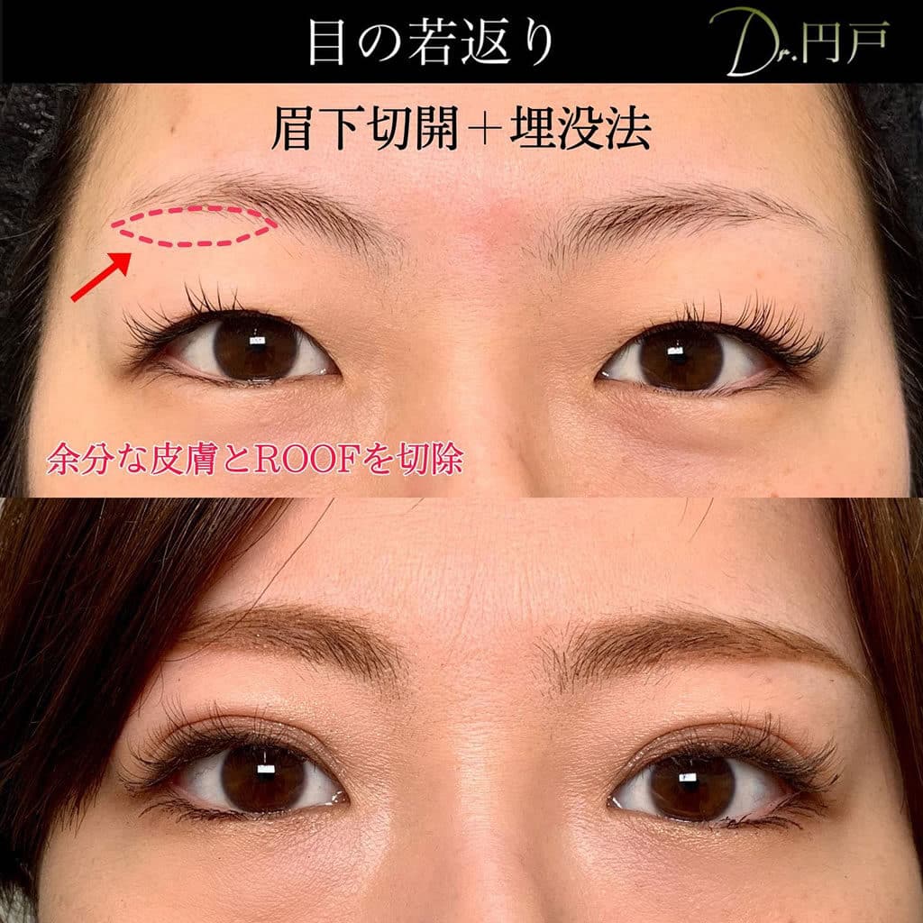 眉下切開と埋没法の症例写真