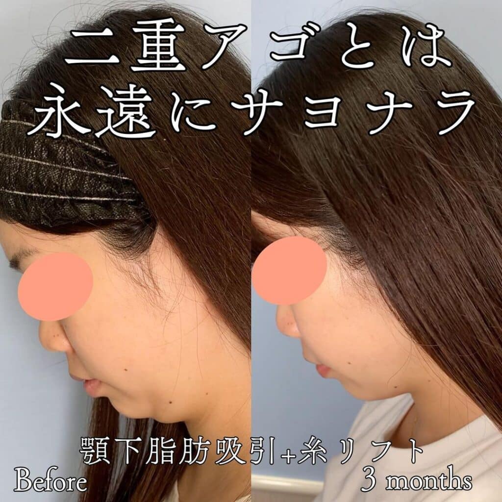 顎下の脂肪吸引の症例