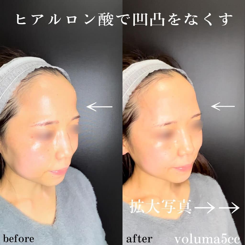 額とこめかみのヒアルロン酸注入の横向きの症例