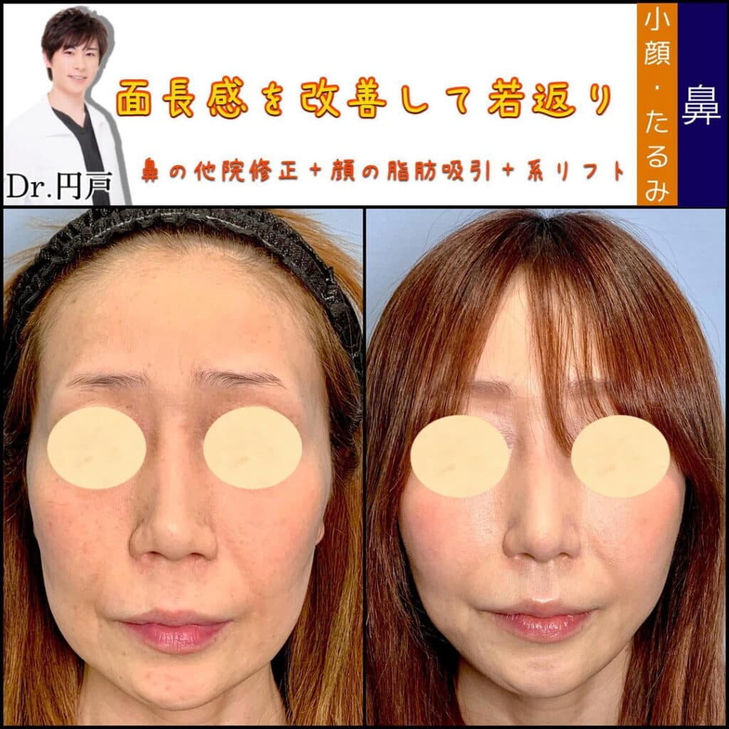 鼻尖形成と軟骨移植と鼻中隔延長と小顔脂肪吸引と糸リフトの症例写真