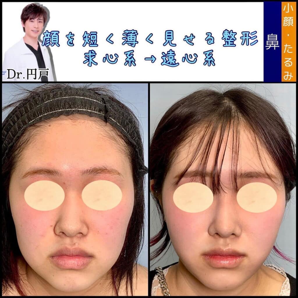 鼻中隔延長とメーラーファットと顔の脂肪吸引 (2)