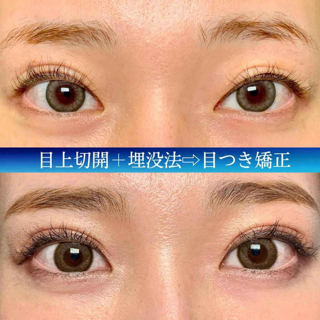 目上切開と埋没法