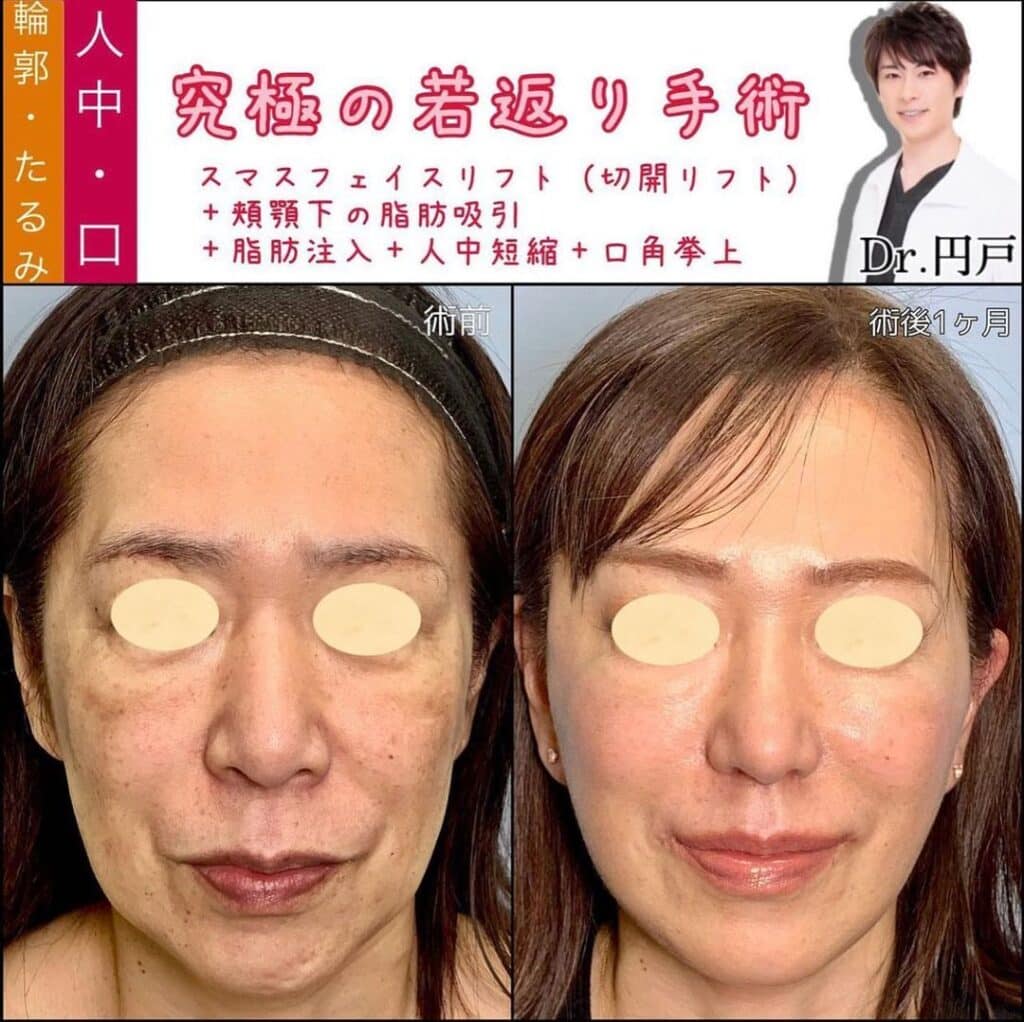 切開リフトと顔の脂肪吸引と脂肪注入と人中短縮と口角挙上の症例写真 (2)