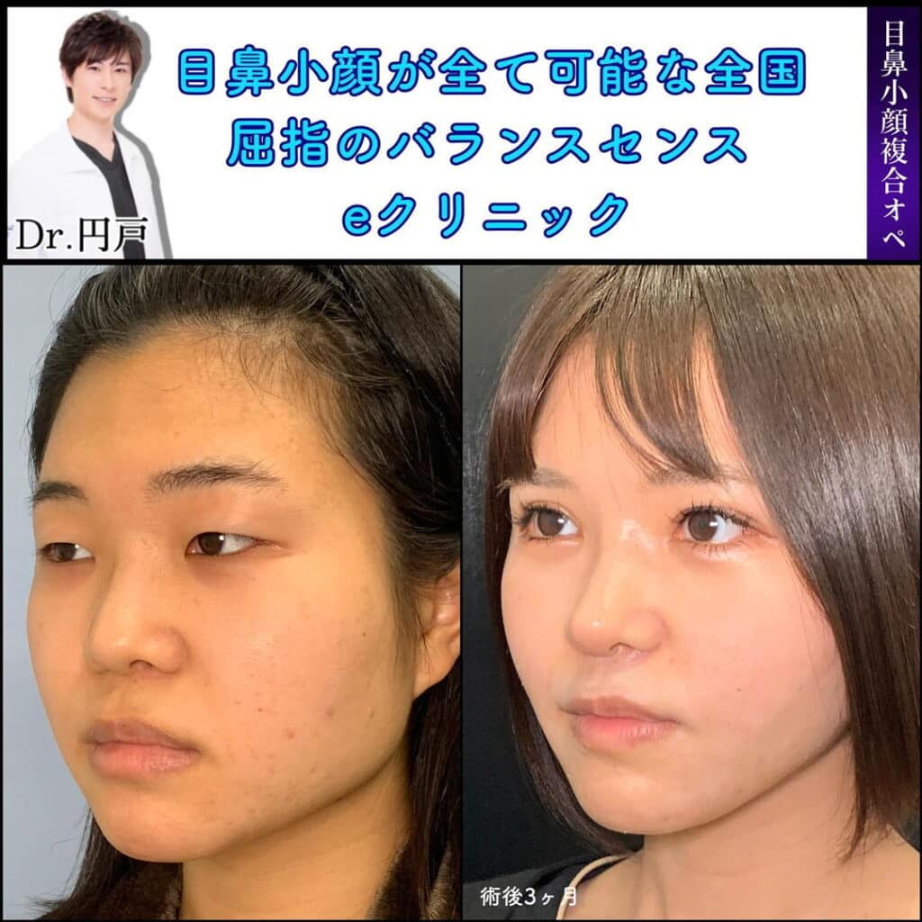 目フル（目頭、下瞼拡大、目尻靱帯移動、眼瞼下垂、全切開）＋鼻フル（小鼻縮小、鼻尖形成＋軟骨移植＋鼻中隔延長＋オステオポール除去）＋小顔脂肪吸引＋糸リフト