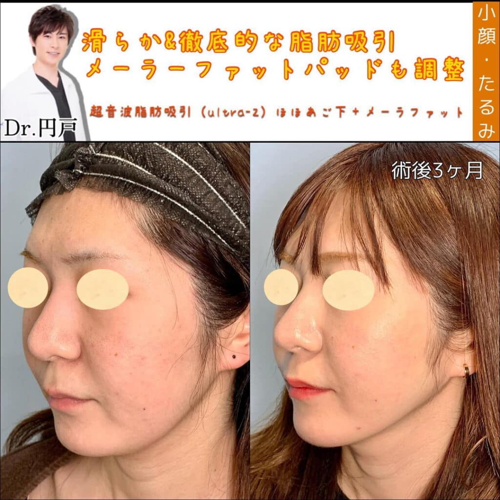 顔の脂肪吸引とメーラーファット除去 (1)