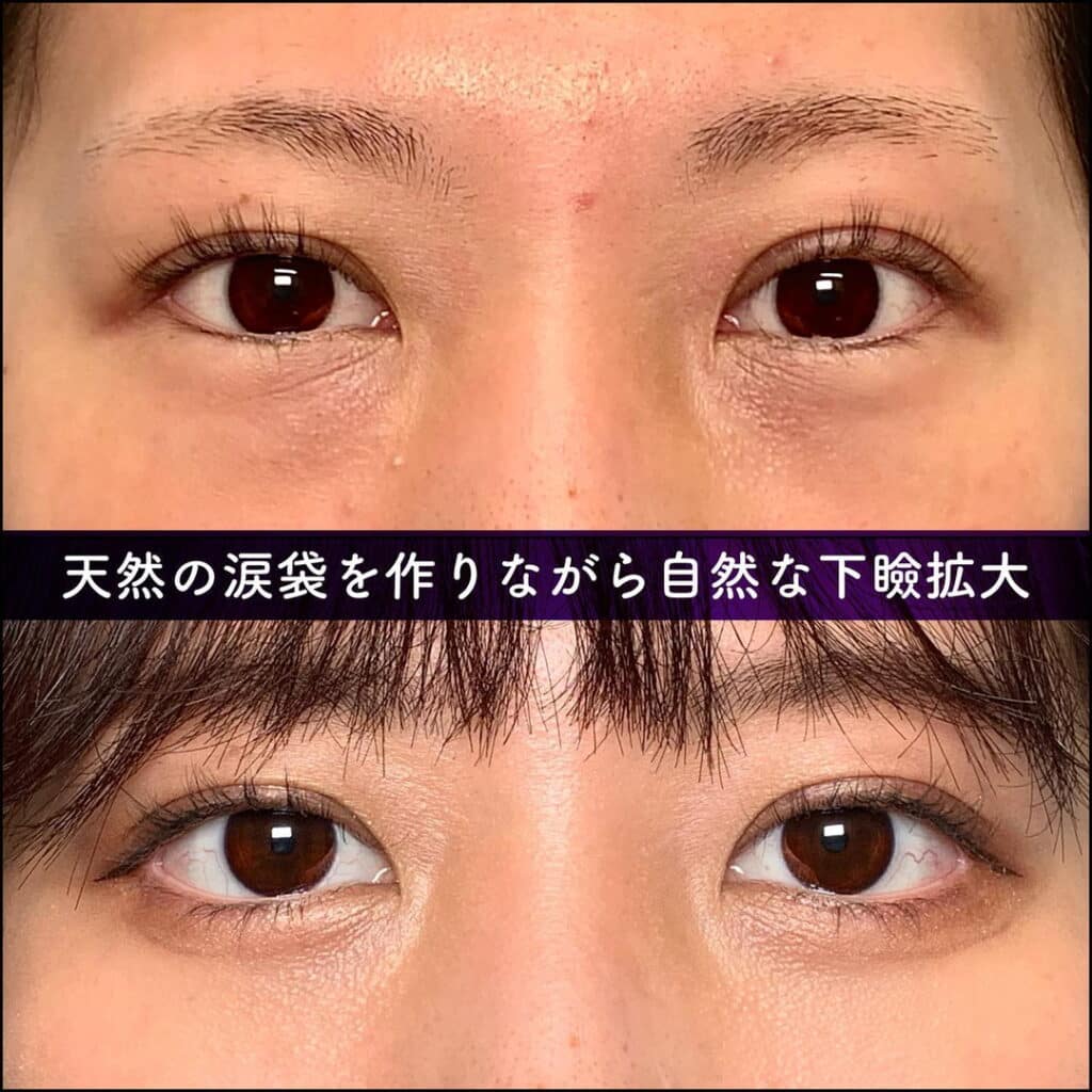 下瞼拡大の症例写真
