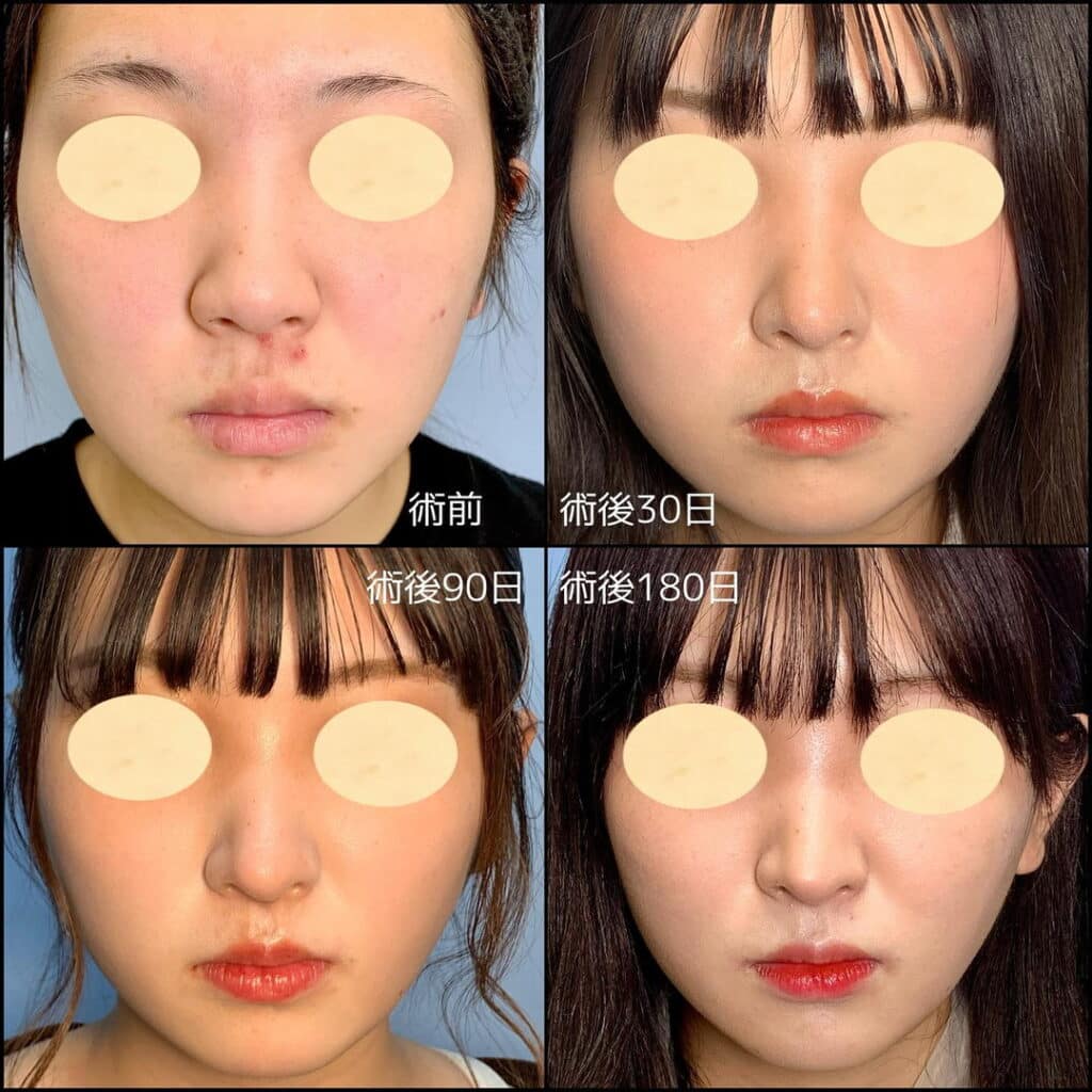 小顔脂肪吸引と鼻整形 (2)