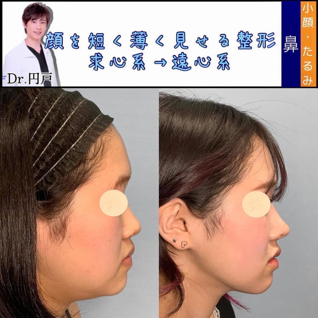 鼻中隔延長とメーラーファットと顔の脂肪吸引 (1)