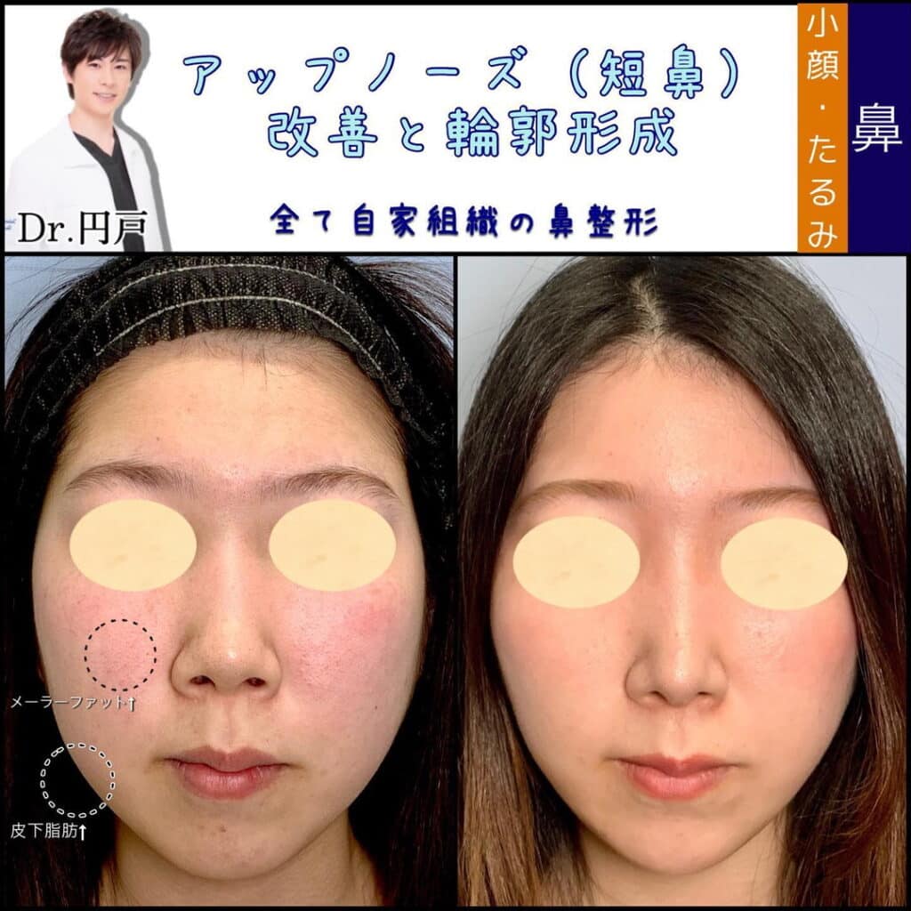 鼻中隔延長耳介、鼻背軟骨移植、鼻尖形成、軟骨移植、メーラーファット