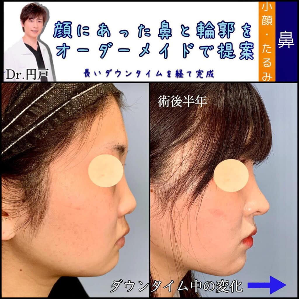 小顔脂肪吸引と鼻整形 (3)