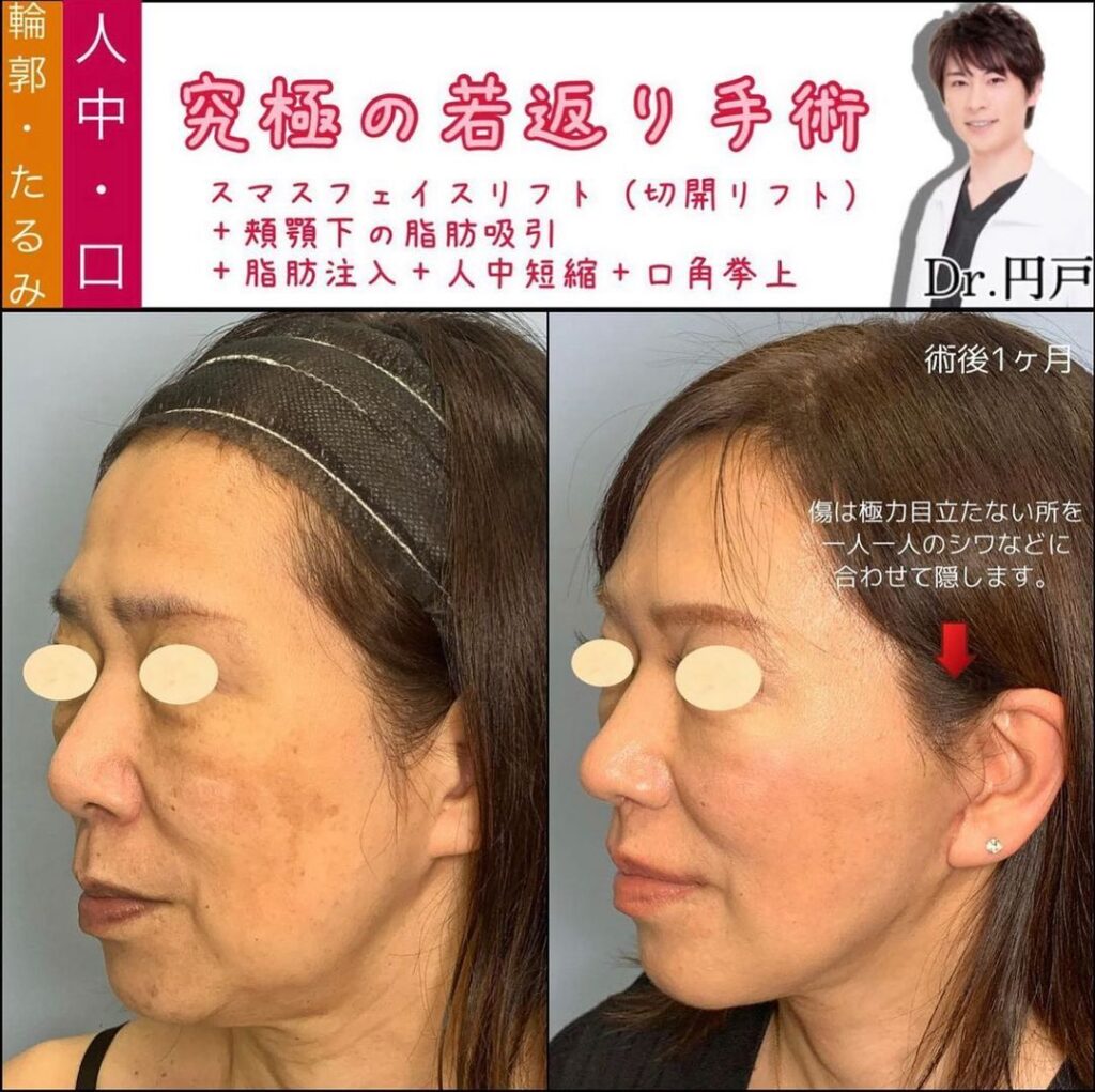 切開リフトと顔の脂肪吸引と脂肪注入と人中短縮と口角挙上の症例写真