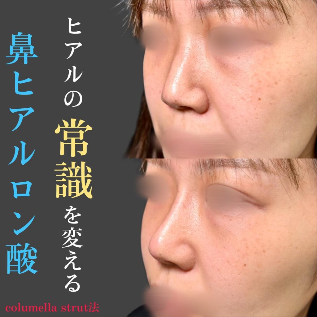 鼻のヒアルロン酸の症例写真
