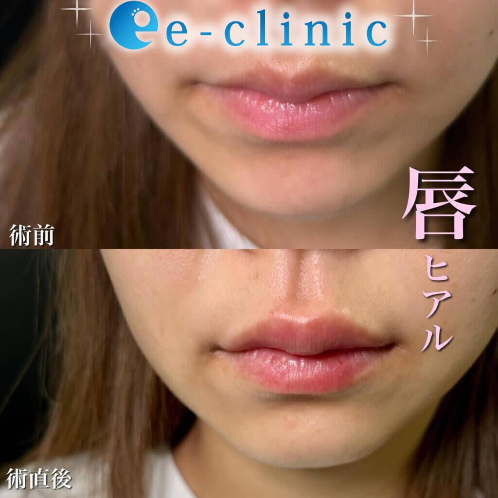 正面から見たの唇のヒアルロン酸の症例.jpg