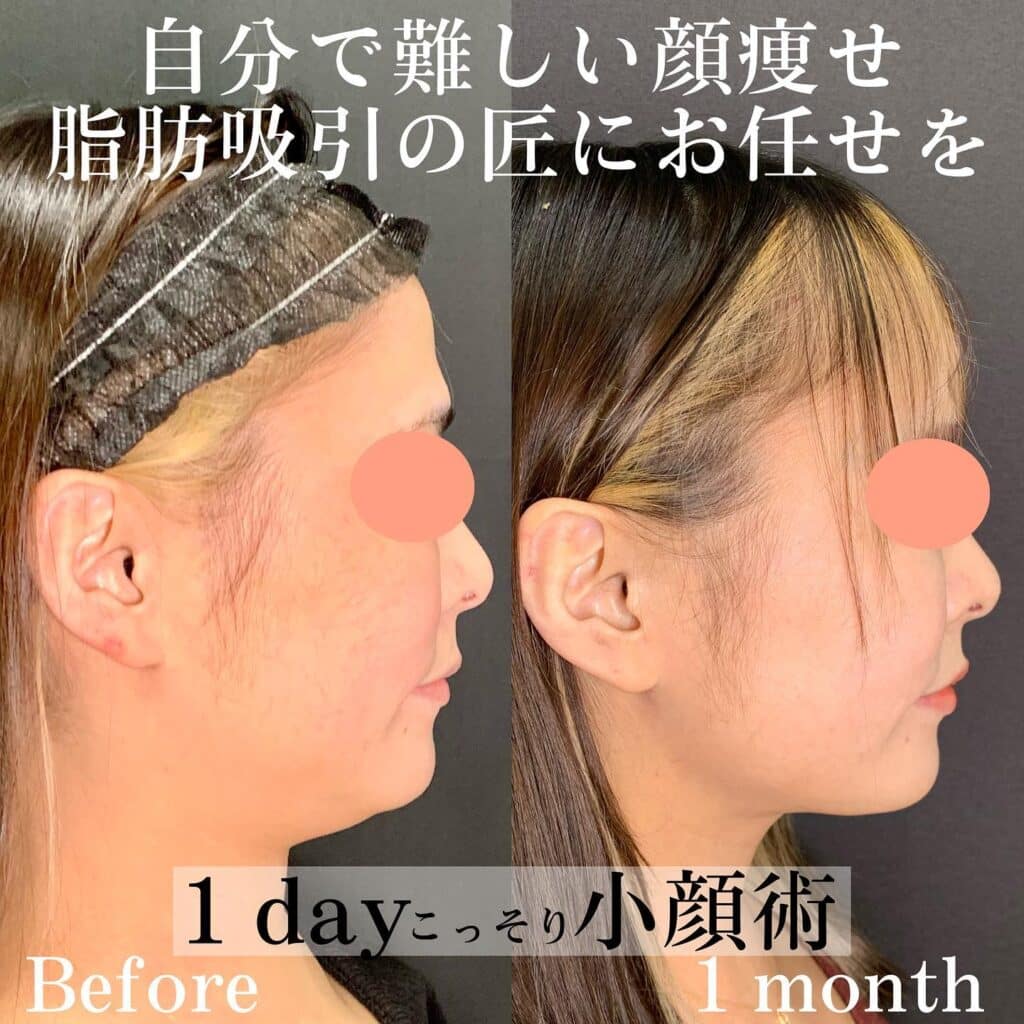 1dayごっそり小顔脂肪吸引の症例写真