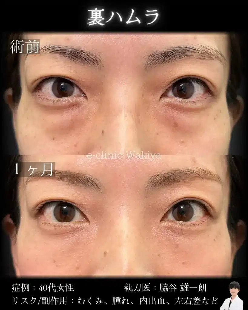 脇谷雄一朗医師　裏ハムラ　クマ取り