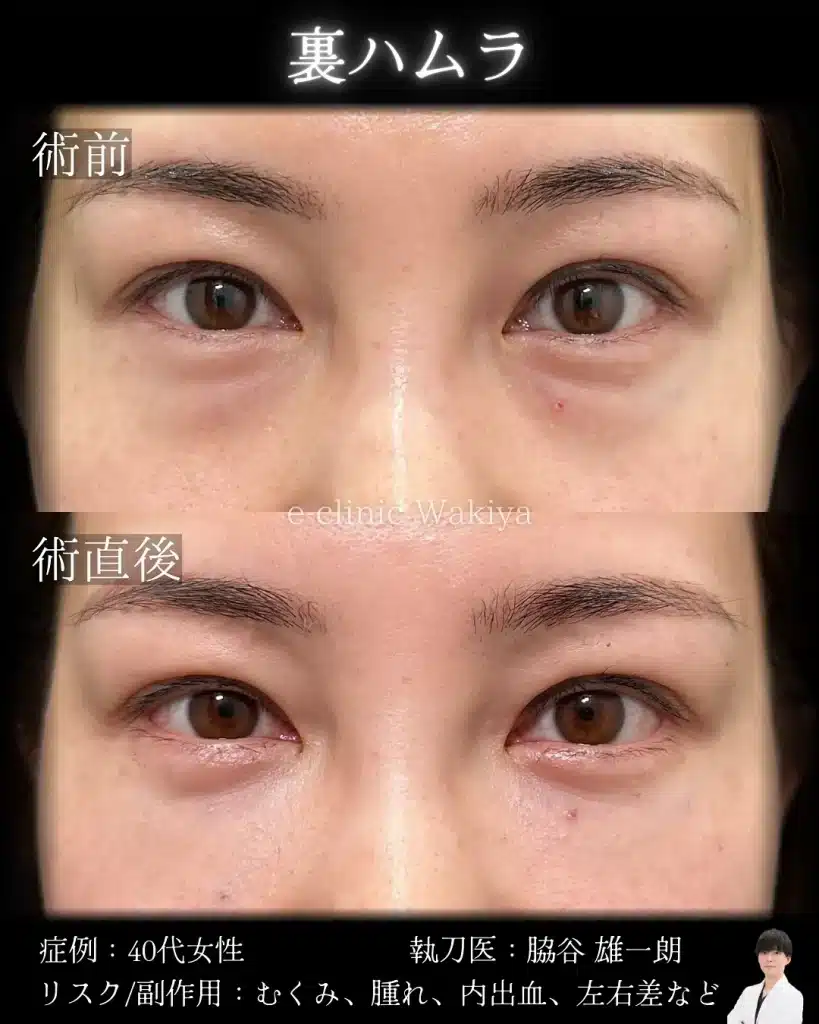 脇谷雄一朗医師　裏ハムラ　クマ取り