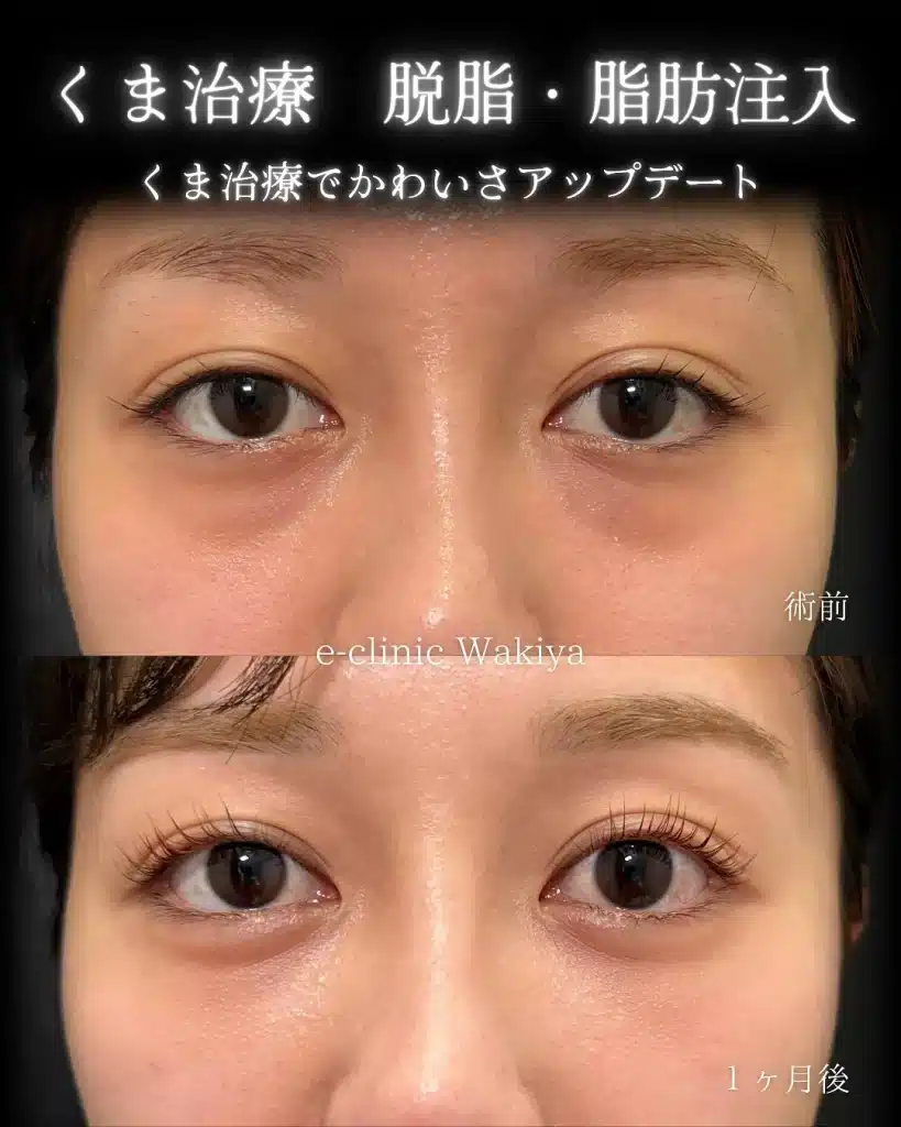 脇谷雄一朗医師　脱脂＋脂肪注入　クマ取り