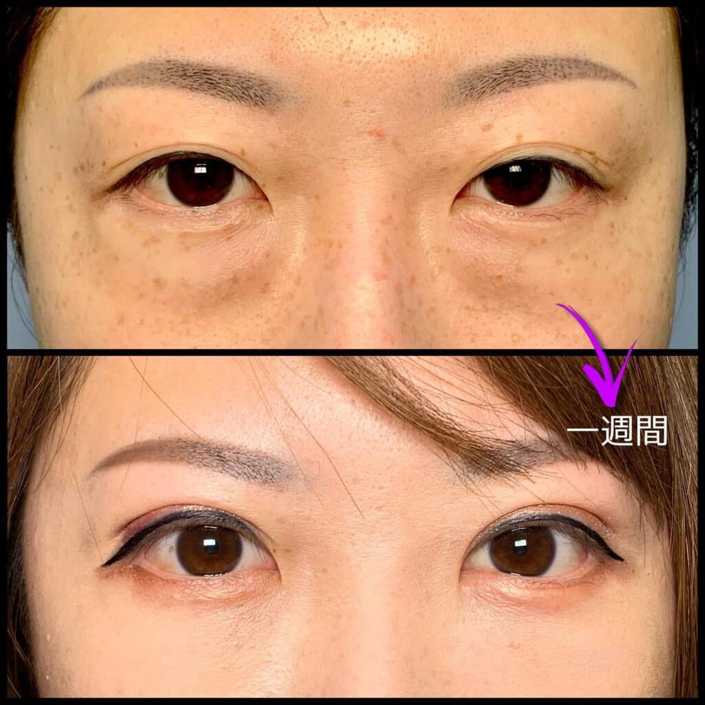 眼瞼下垂と全切開の傷跡の他院修正の1週間後の症例動画.