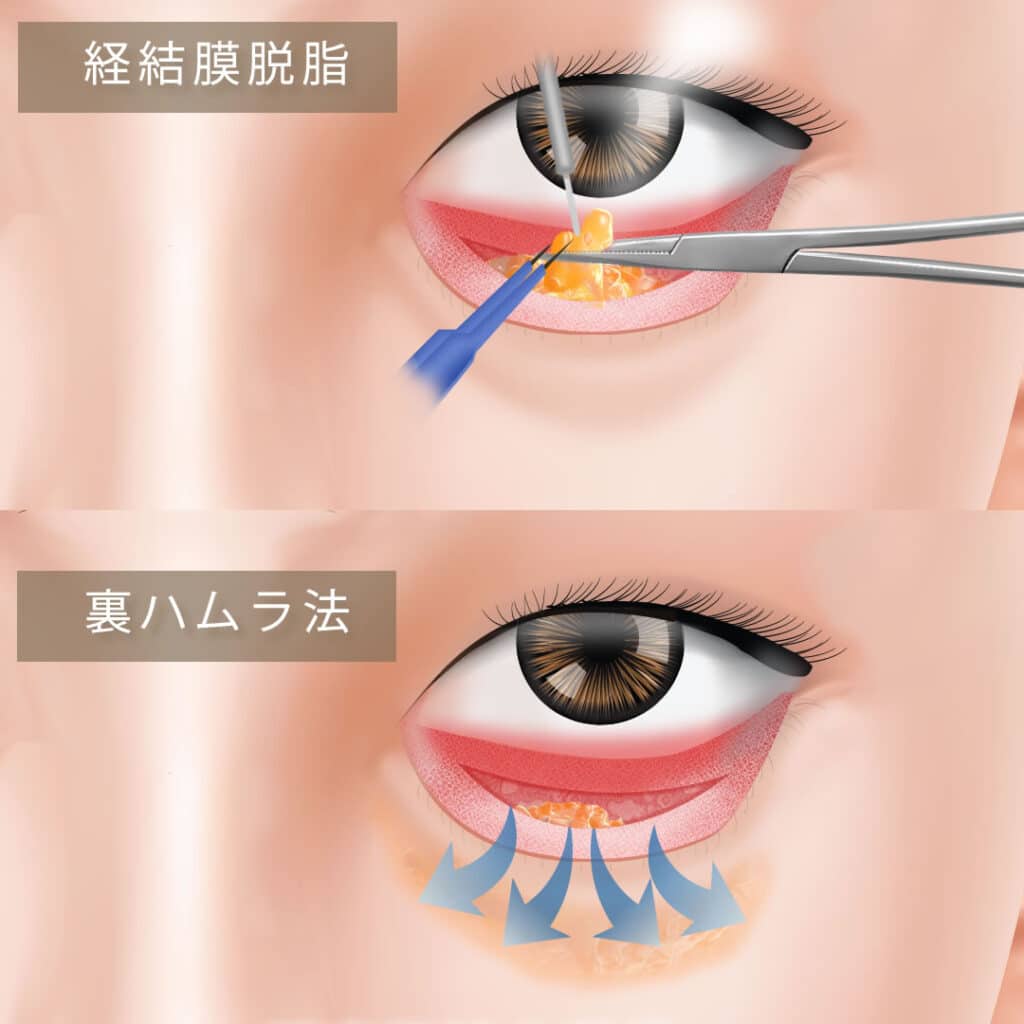 経結膜脱脂と裏ハムラの違いの図解