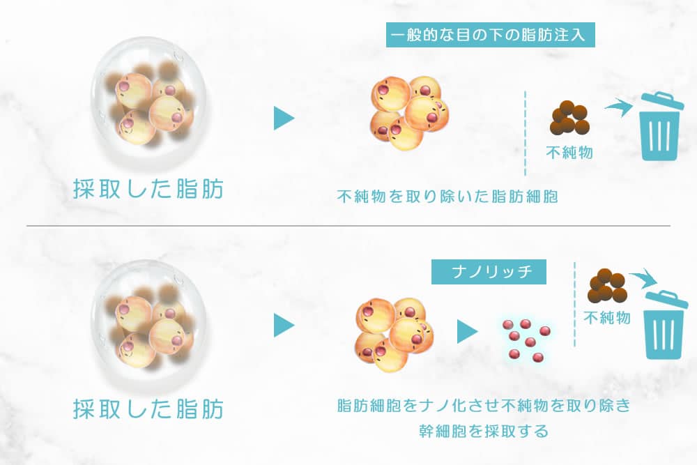 脂肪注入とナノリッチの違いの図解