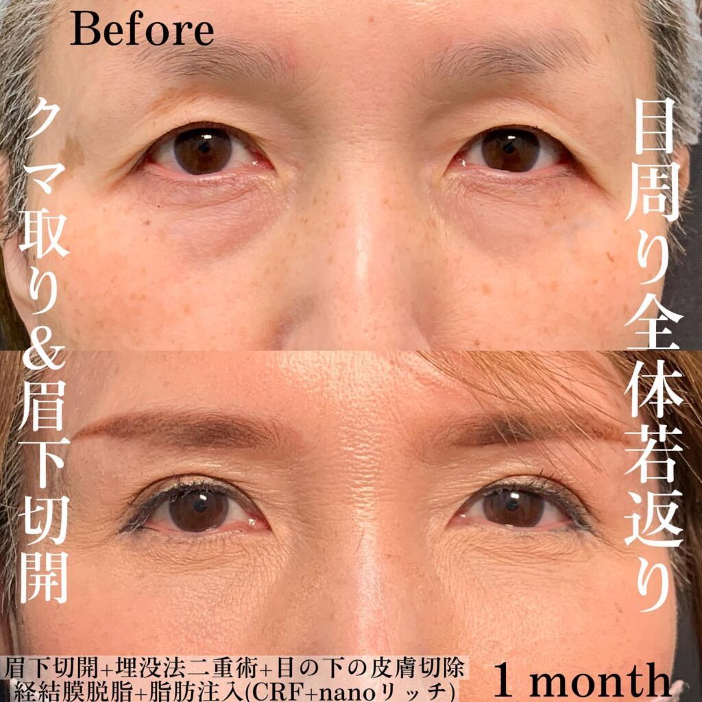 eクリニック大阪院の経結膜脱脂と脂肪注入と埋没法と眉下切開の症例写真(4)