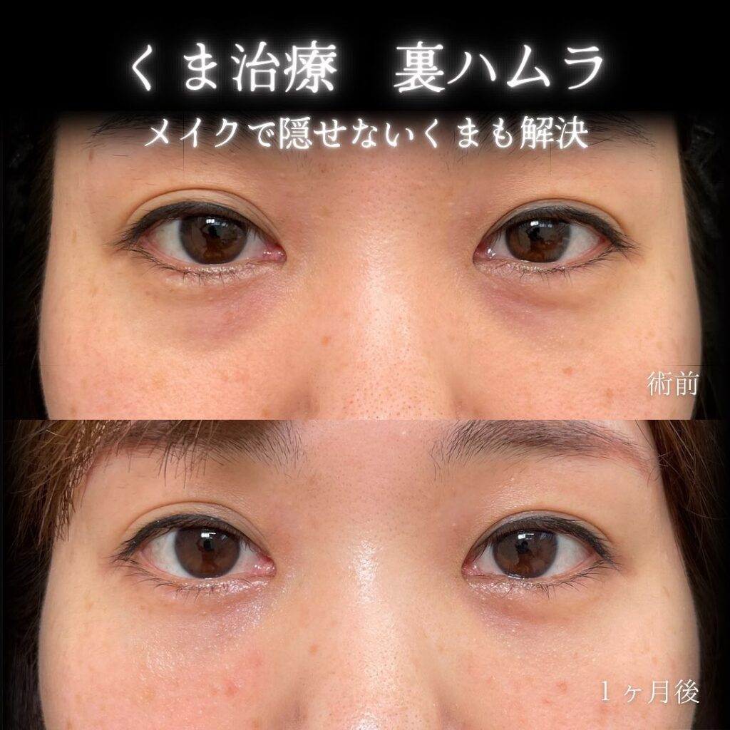 eクリニック大阪院の裏ハムラの症例画像（4）
