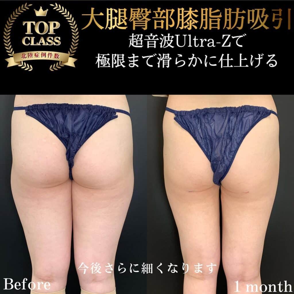 太ももの脂肪吸引の症例写真 (9)