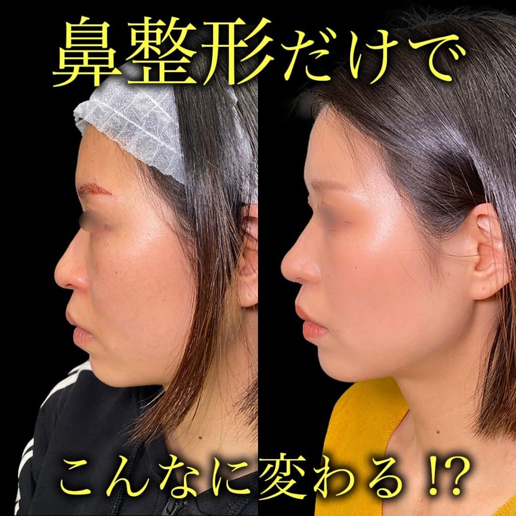 鼻尖形成と耳介軟骨移植と小鼻縮小の症例写真