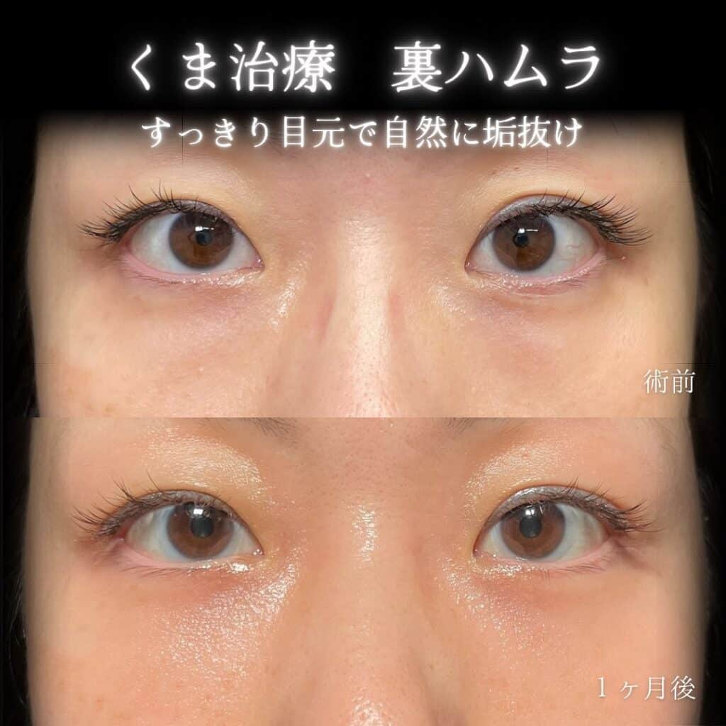 eクリニック大阪院の裏ハムラの症例画像（5）