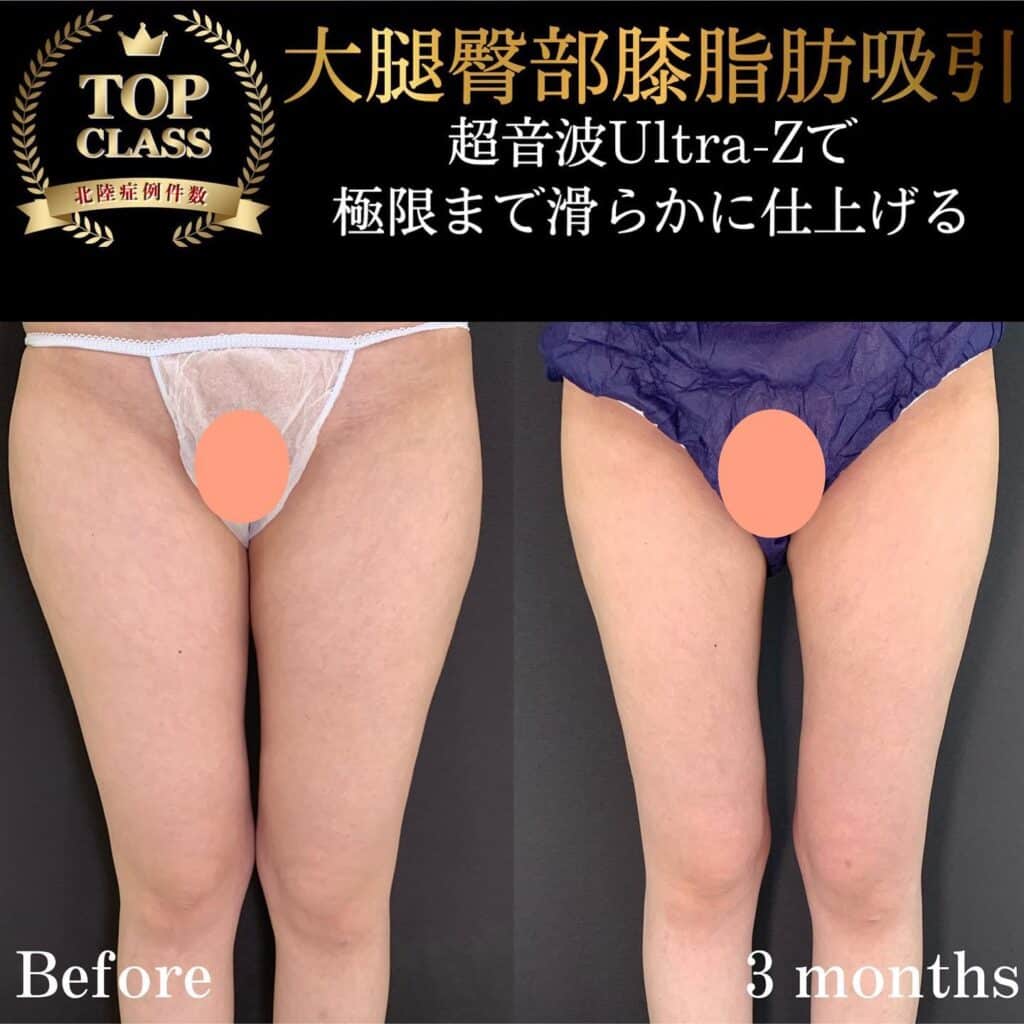 太ももの脂肪吸引の症例写真 (8)